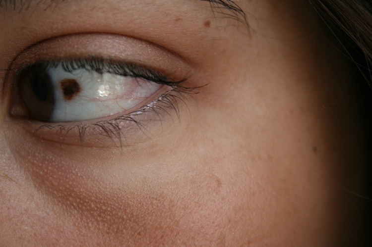 Лечение невуса конъюнктивы глаза